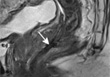 Radiological and clinical findings following rectal contact X-ray brachytherapy (Papillon technique) - how to assess response