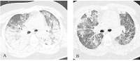 Implementation of veno-venous extracorporeal membrane oxygenation in a COVID-19 convalescent