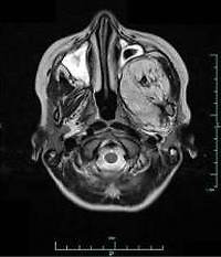 Infratemporal fibrolipoma in a 9-year-old female patient