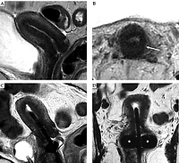 Pictorial essay: Magnetic resonance imaging in cervical cancer interventional radiotherapy (brachytherapy): 
a pictorial essay focused on radiologist management